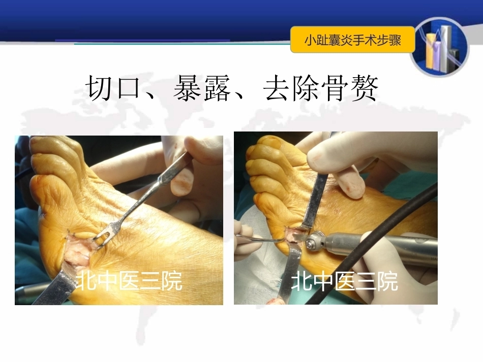 小趾囊 炎_第13页