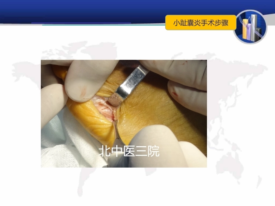小趾囊 炎_第14页