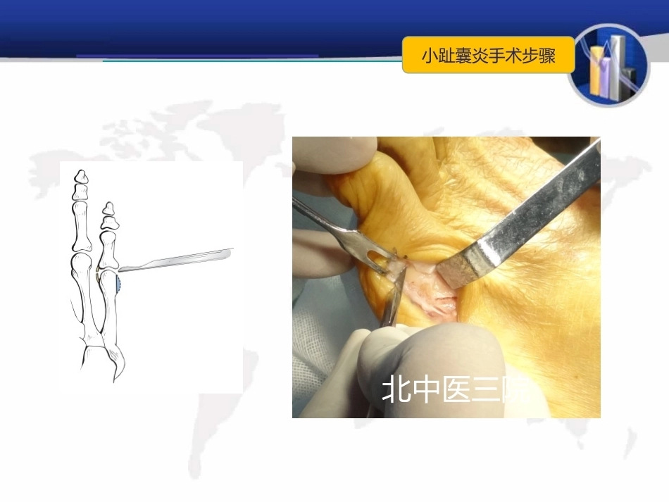小趾囊 炎_第15页