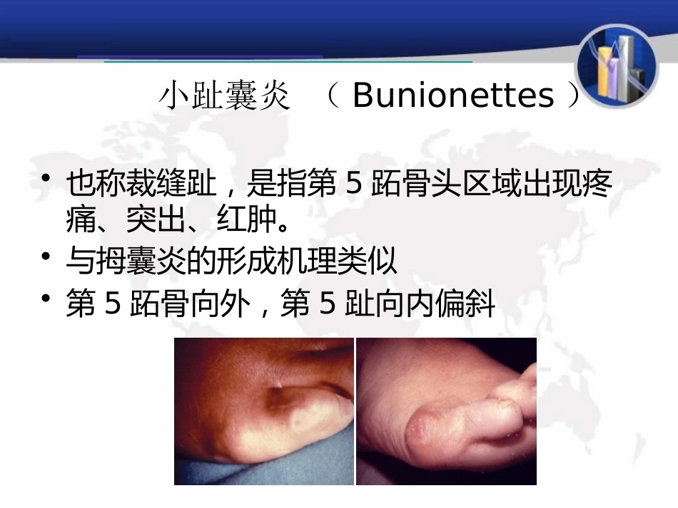 小趾囊 炎_第2页