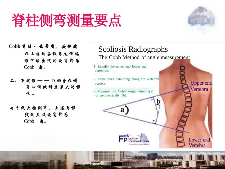 脊柱侧弯的诊 断及治疗_第10页