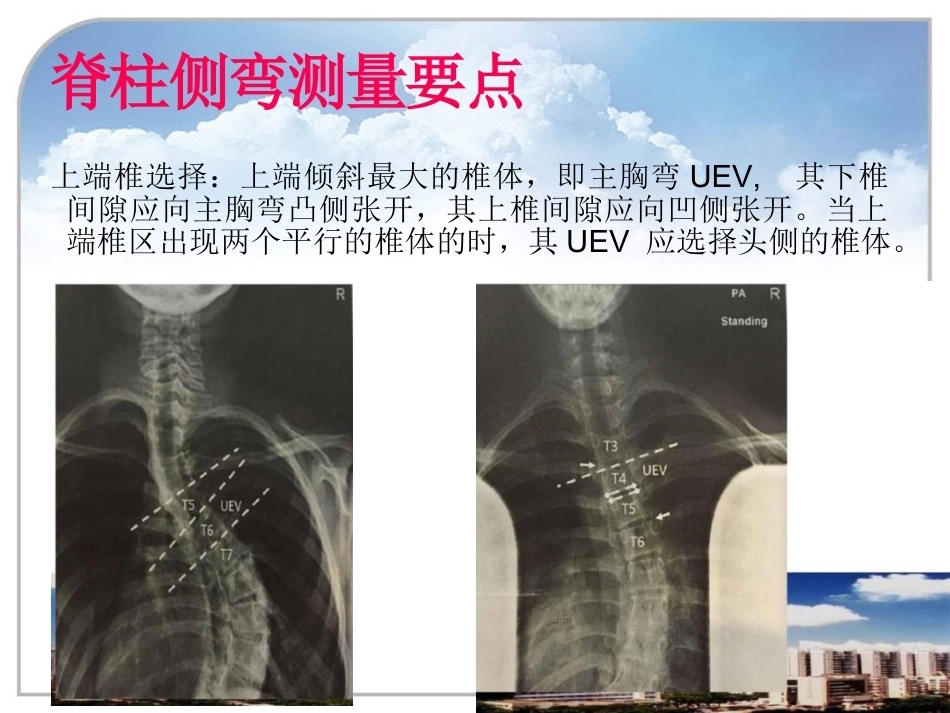 脊柱侧弯的诊 断及治疗_第11页