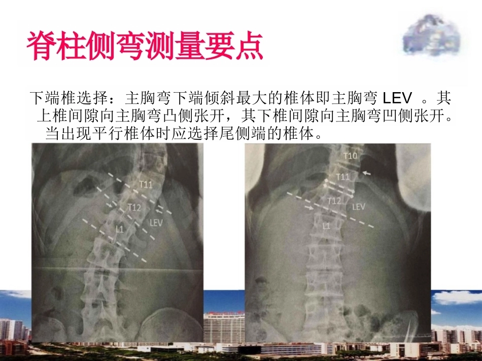脊柱侧弯的诊 断及治疗_第12页