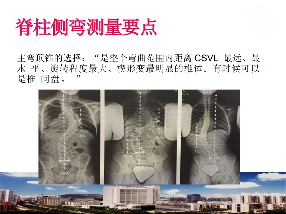 脊柱侧弯的诊 断及治疗_第13页
