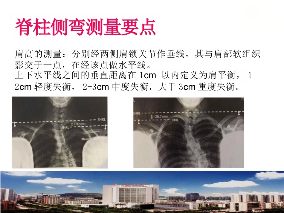 脊柱侧弯的诊 断及治疗_第15页