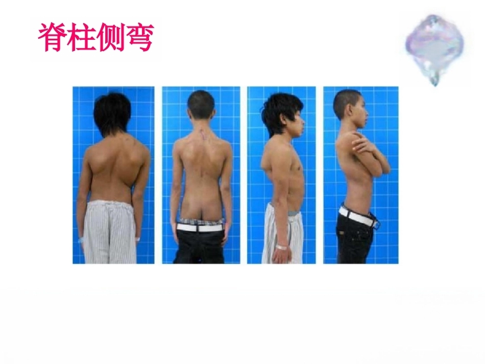 脊柱侧弯的诊 断及治疗_第2页