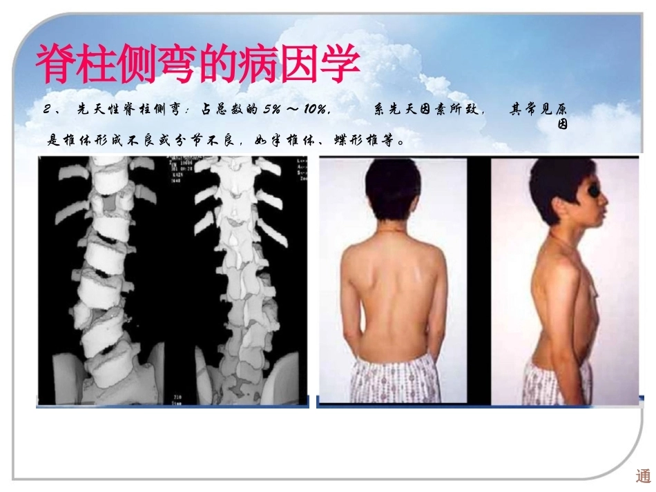 脊柱侧弯的诊 断及治疗_第5页