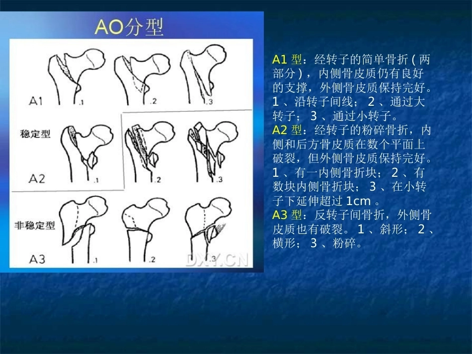 股骨转子间骨折的分型、治疗_第14页