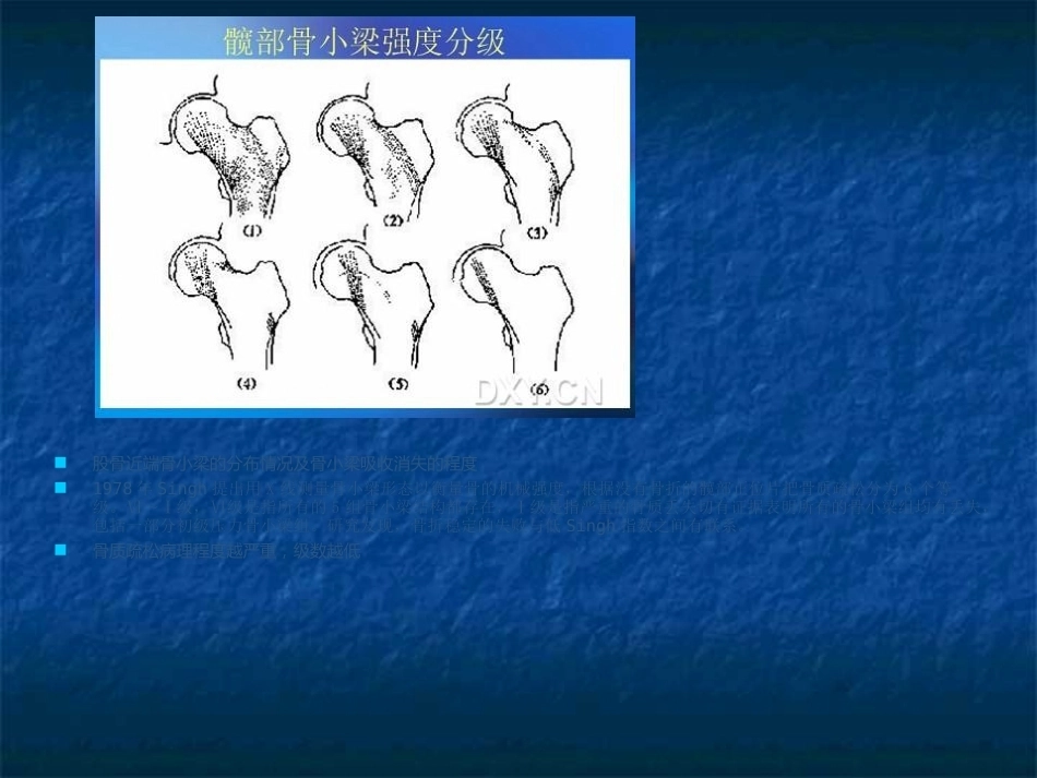 股骨转子间骨折的分型、治疗_第6页
