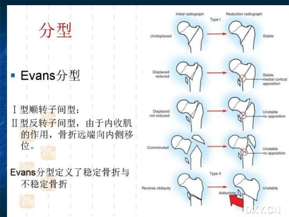 股骨转子间骨折的分型、治疗_第9页