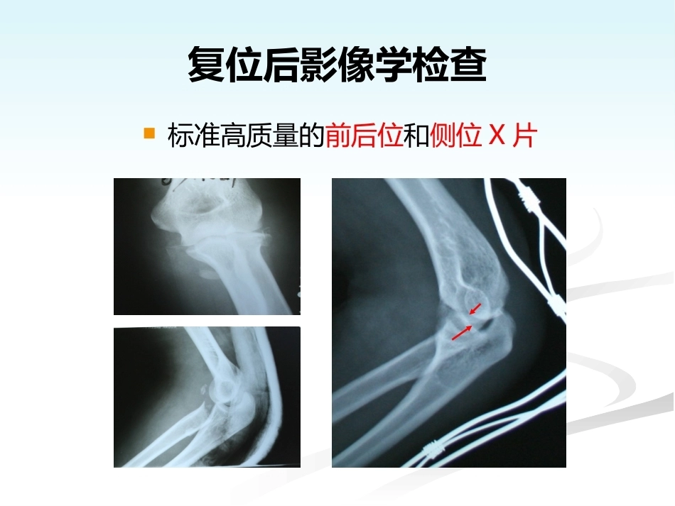 肘关节恐怖三联征的规范化外科治修改_第15页