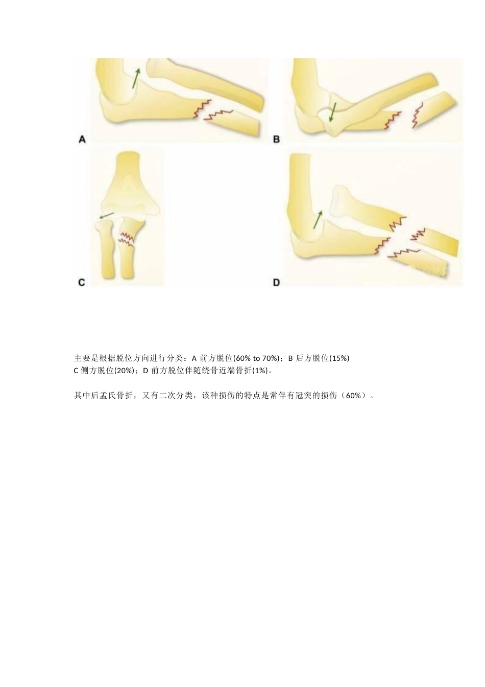 孟氏骨折的分类_第6页