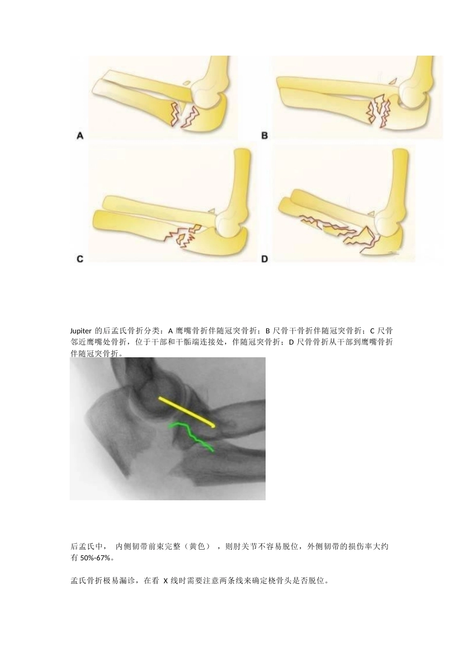 孟氏骨折的分类_第7页