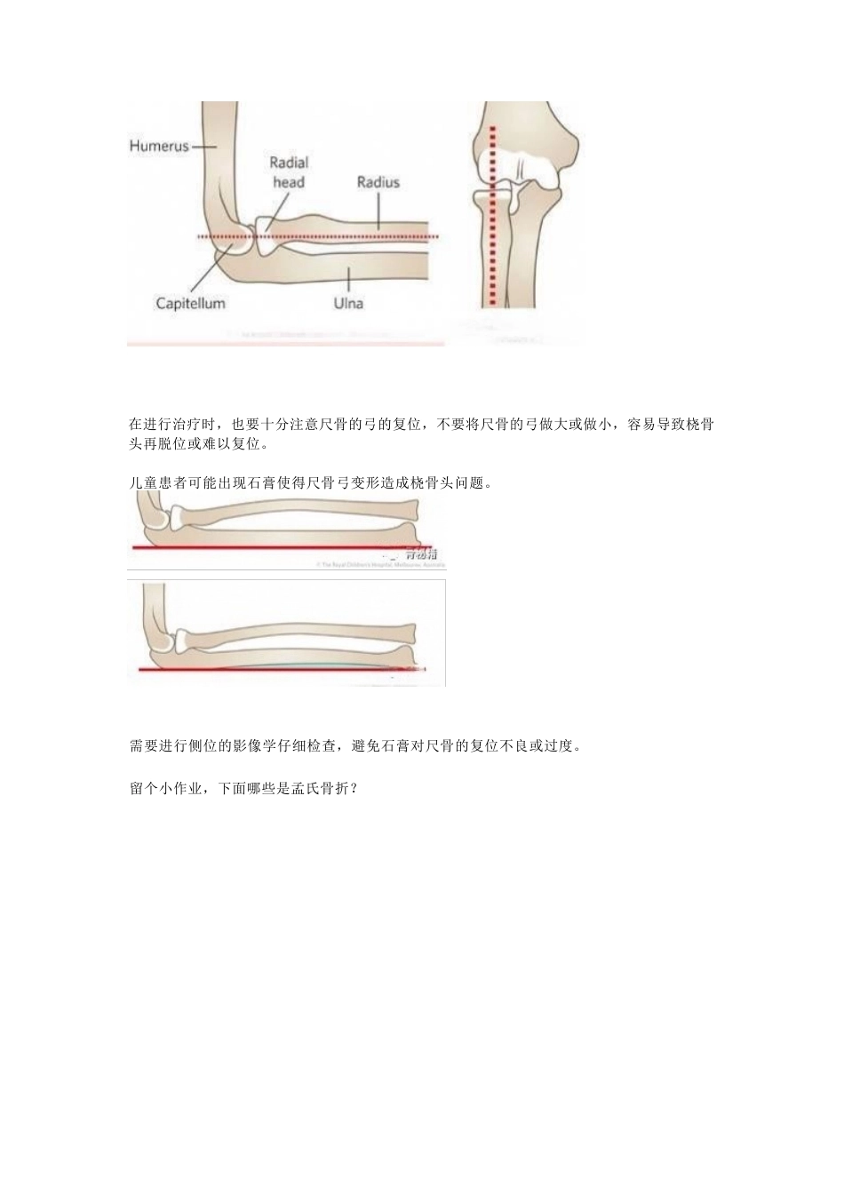 孟氏骨折的分类_第8页
