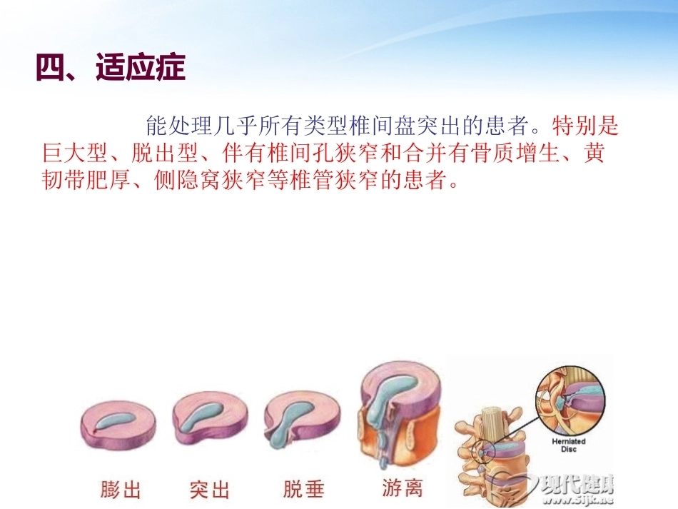 椎间孔镜 技术_第14页