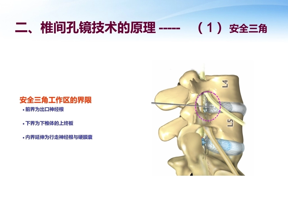 椎间孔镜 技术_第3页