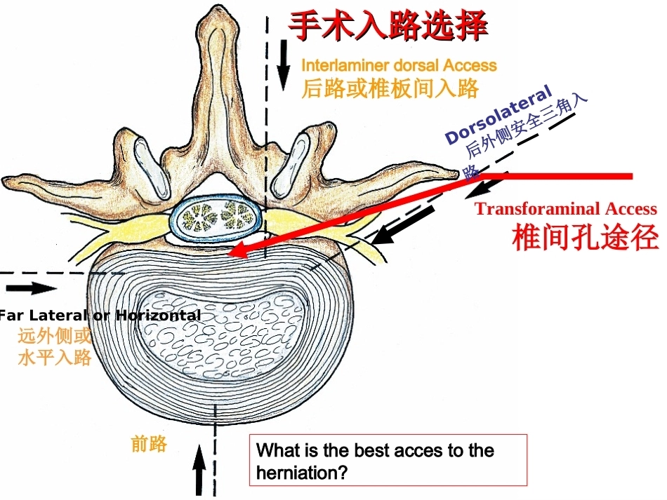 椎间孔镜 技术_第5页