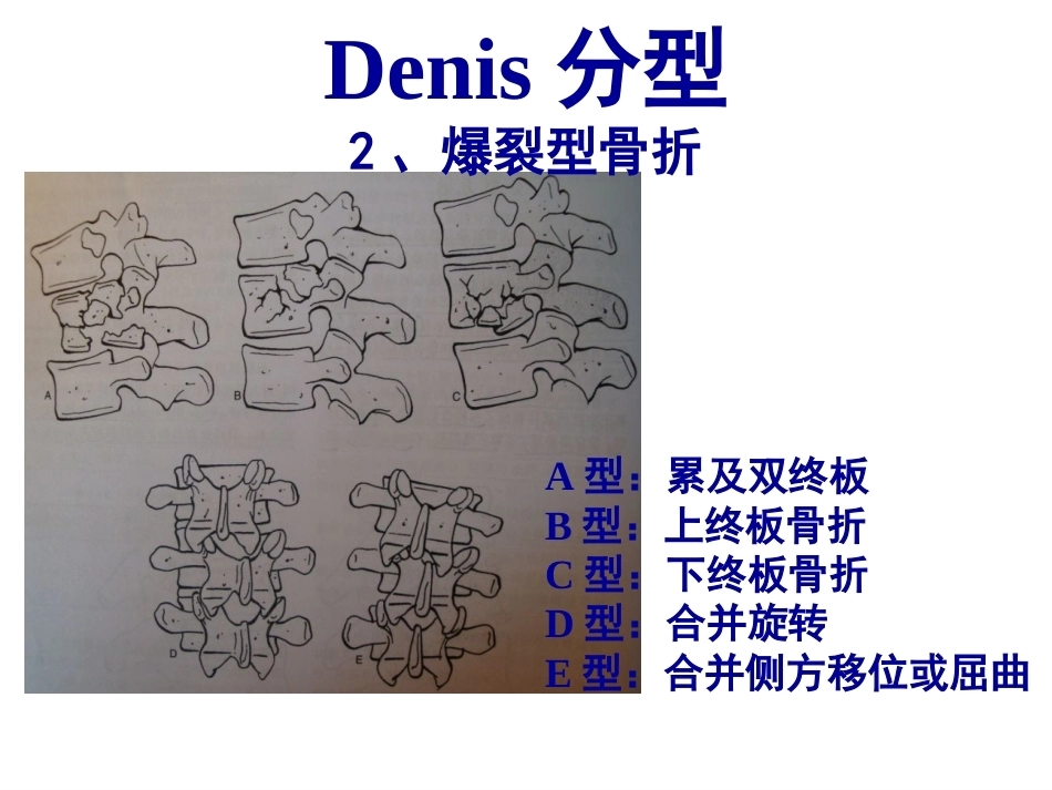 胸腰段脊柱骨折内固 定范围的选择_第11页