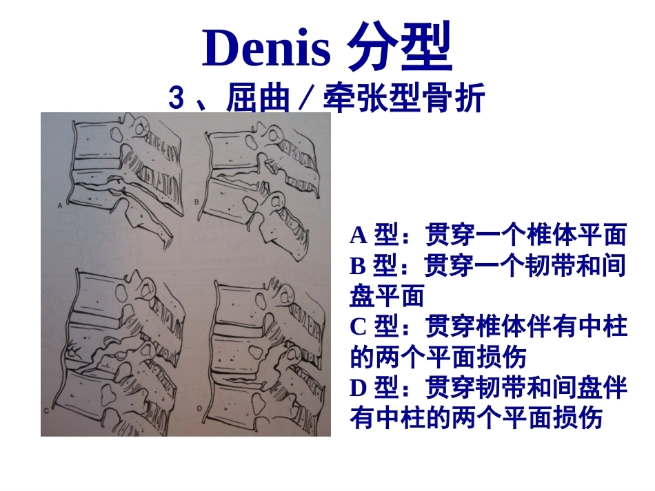 胸腰段脊柱骨折内固 定范围的选择_第12页