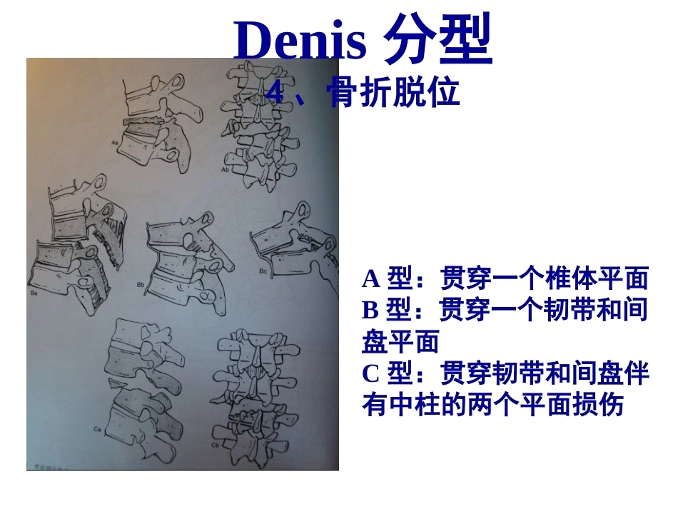 胸腰段脊柱骨折内固 定范围的选择_第13页