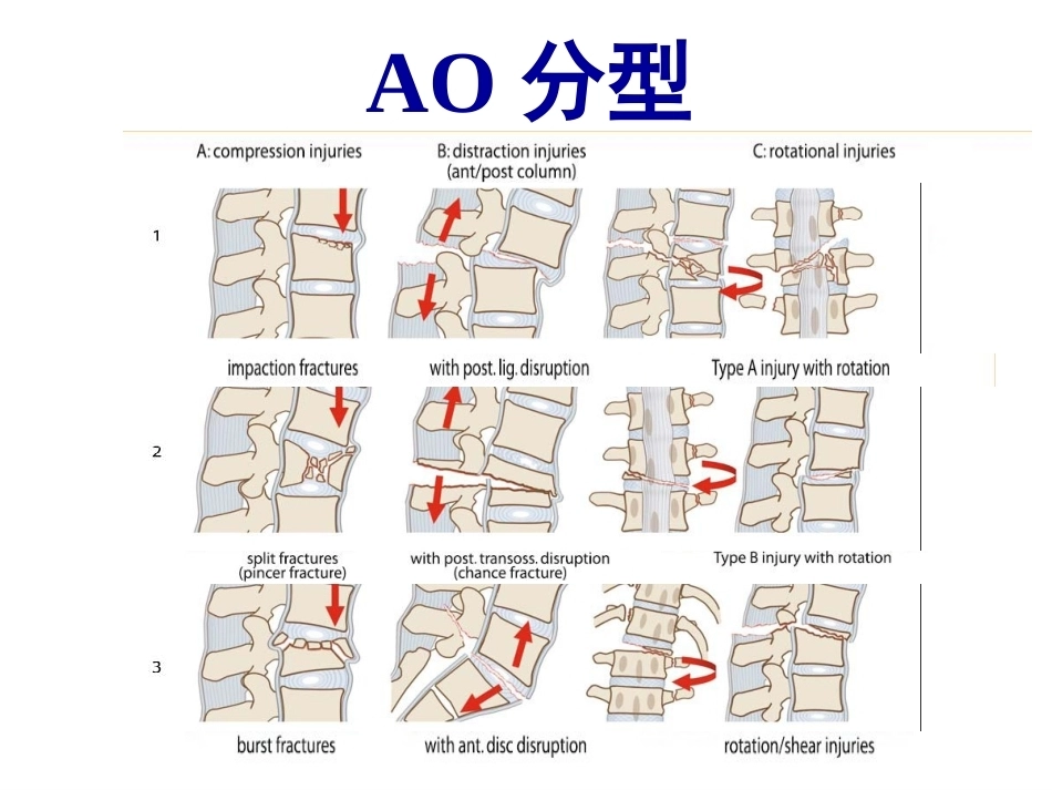 胸腰段脊柱骨折内固 定范围的选择_第14页