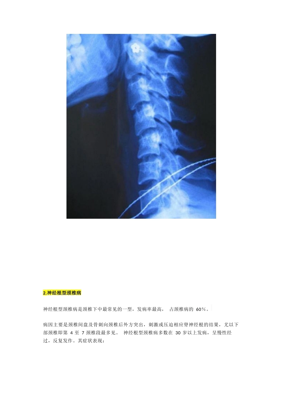 颈椎病分型及临床表现_第3页