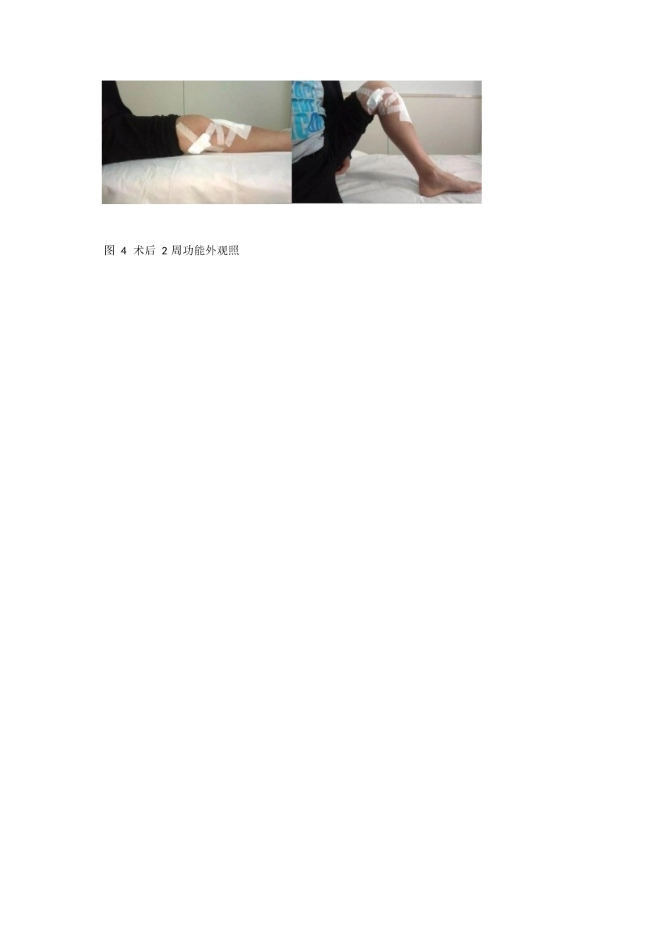 胫骨平台骨折的分型_第6页