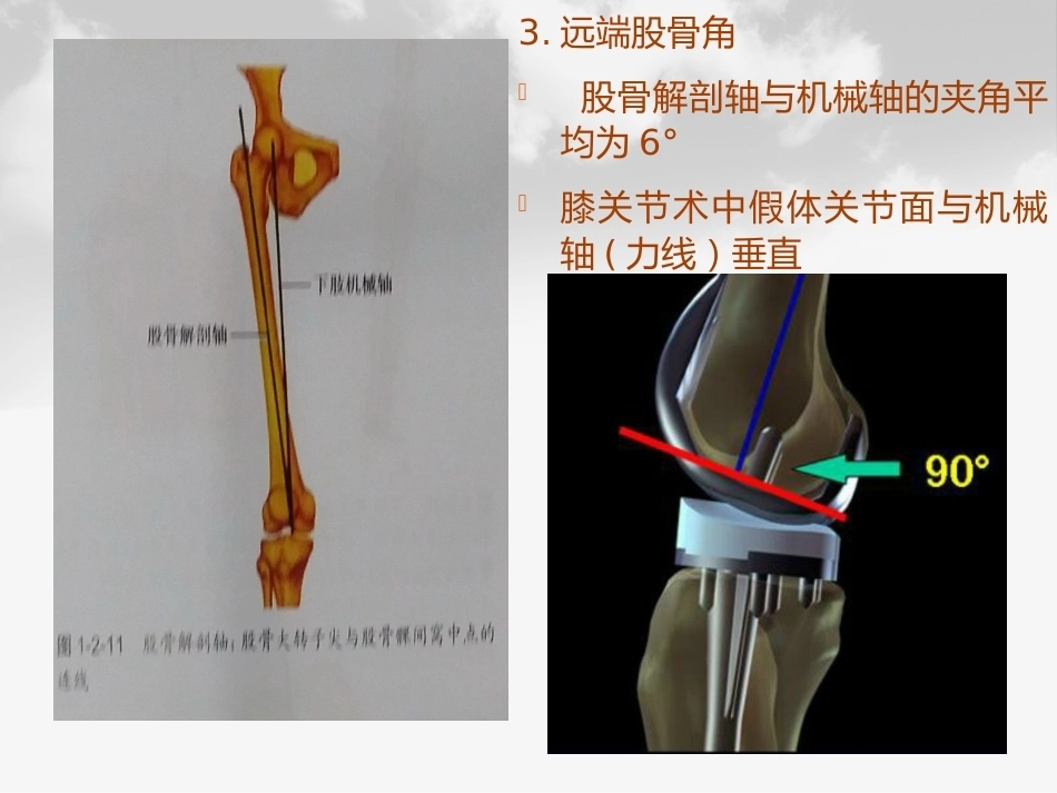 全膝膝关节 置换基本理论_第13页