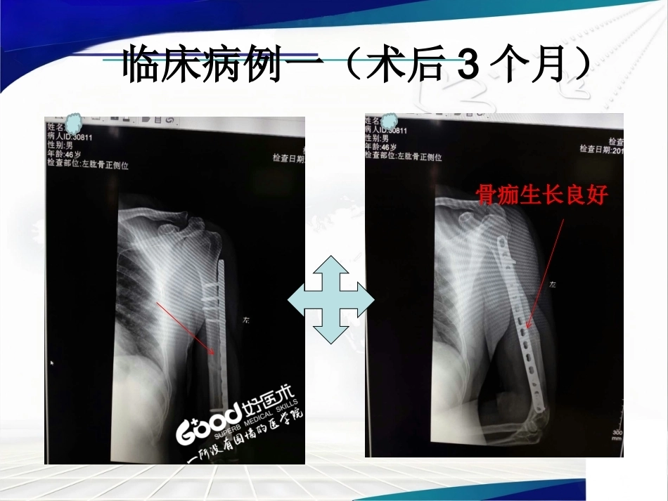 经皮微创锁定钢板治疗肱骨骨折_第10页