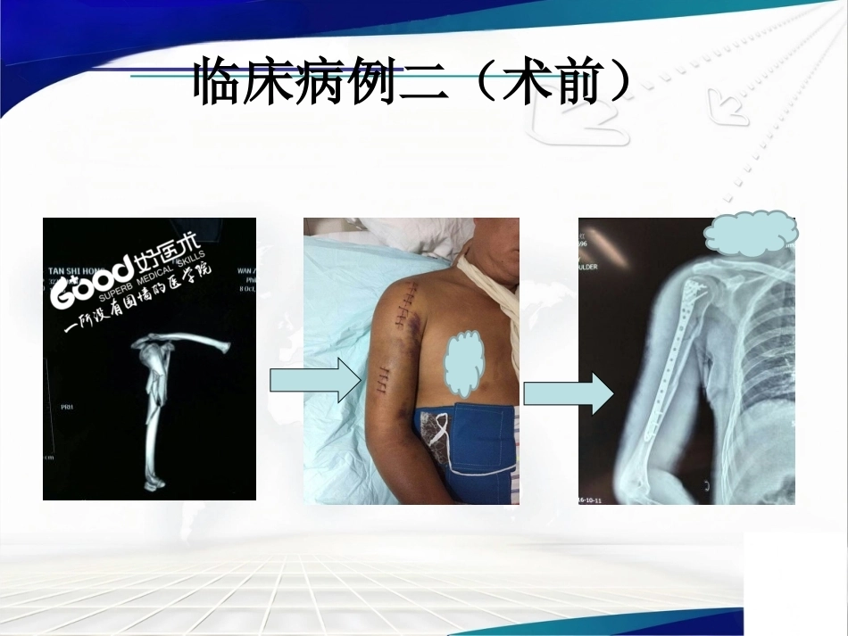 经皮微创锁定钢板治疗肱骨骨折_第11页