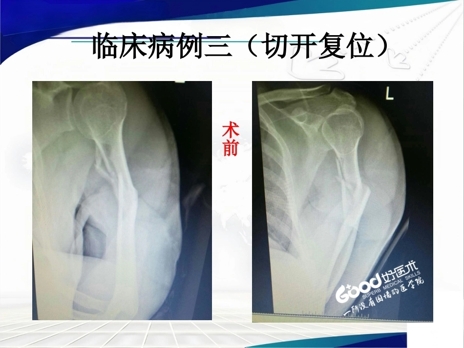 经皮微创锁定钢板治疗肱骨骨折_第12页