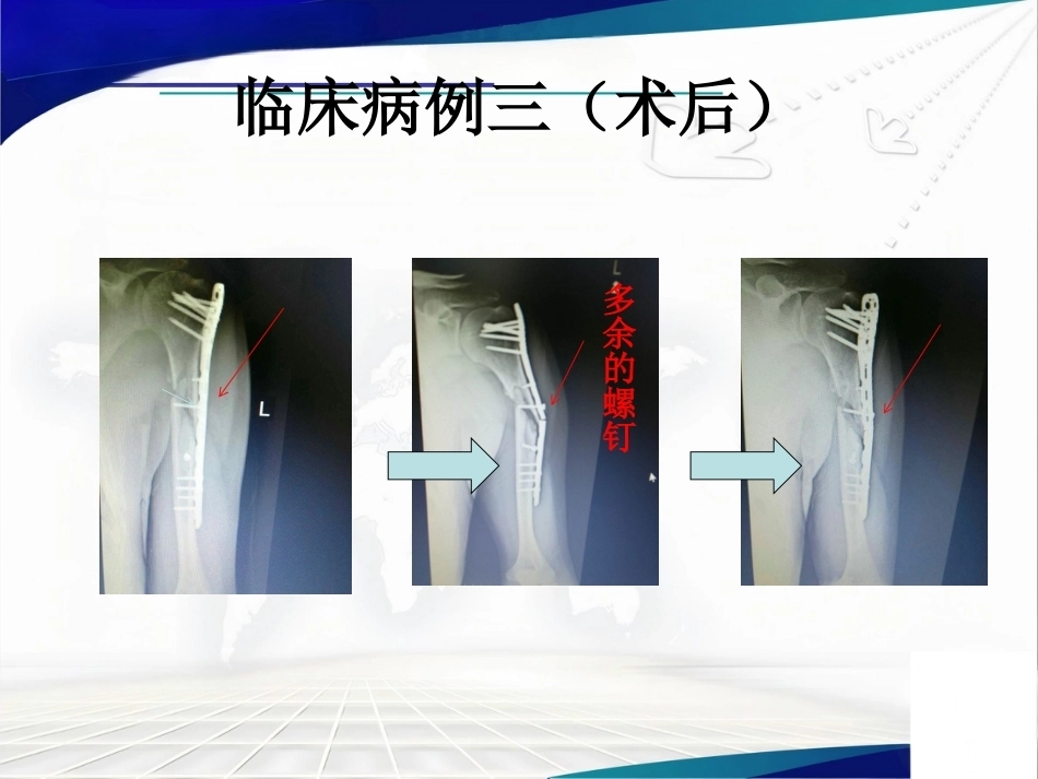 经皮微创锁定钢板治疗肱骨骨折_第13页