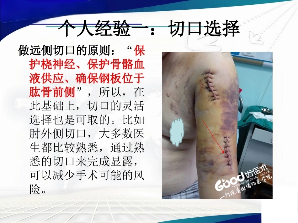 经皮微创锁定钢板治疗肱骨骨折_第15页