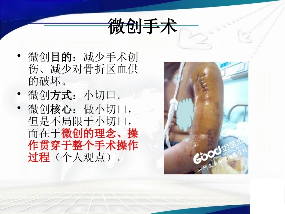 经皮微创锁定钢板治疗肱骨骨折_第2页