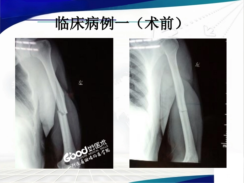经皮微创锁定钢板治疗肱骨骨折_第8页
