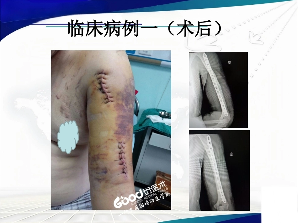 经皮微创锁定钢板治疗肱骨骨折_第9页