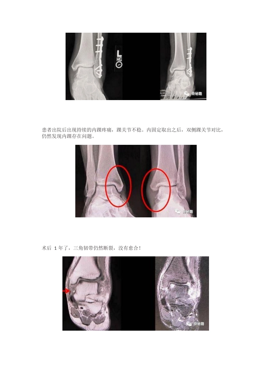 内踝三角韧带 应力测试_第7页