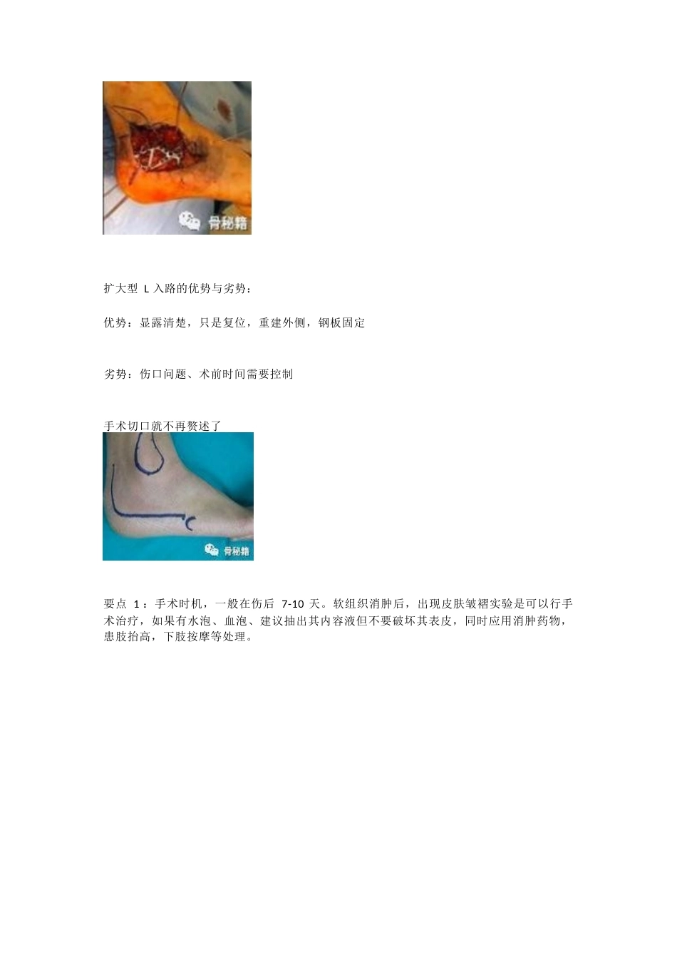 跟骨骨折的切口与 缝合技巧_第3页