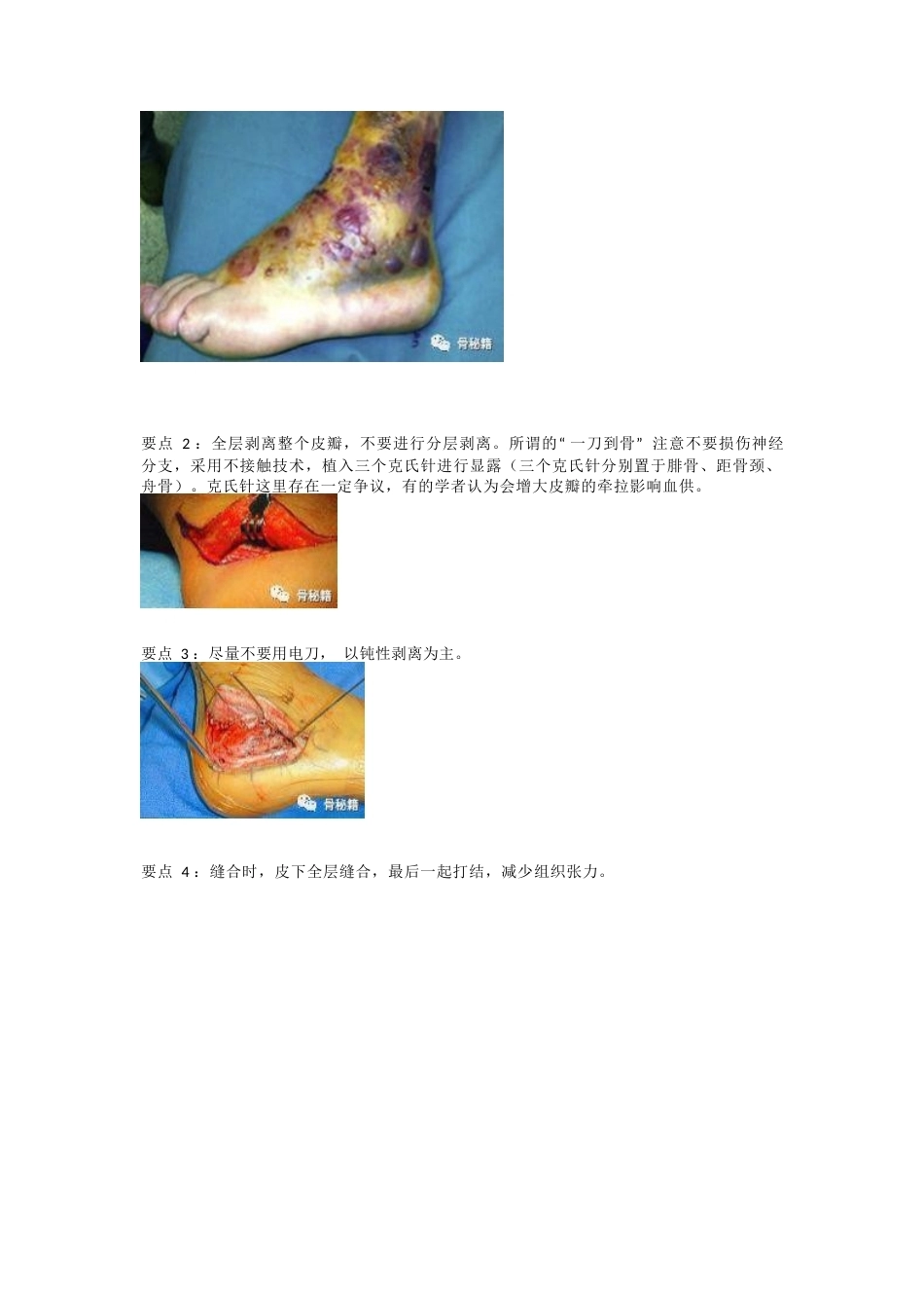 跟骨骨折的切口与 缝合技巧_第4页