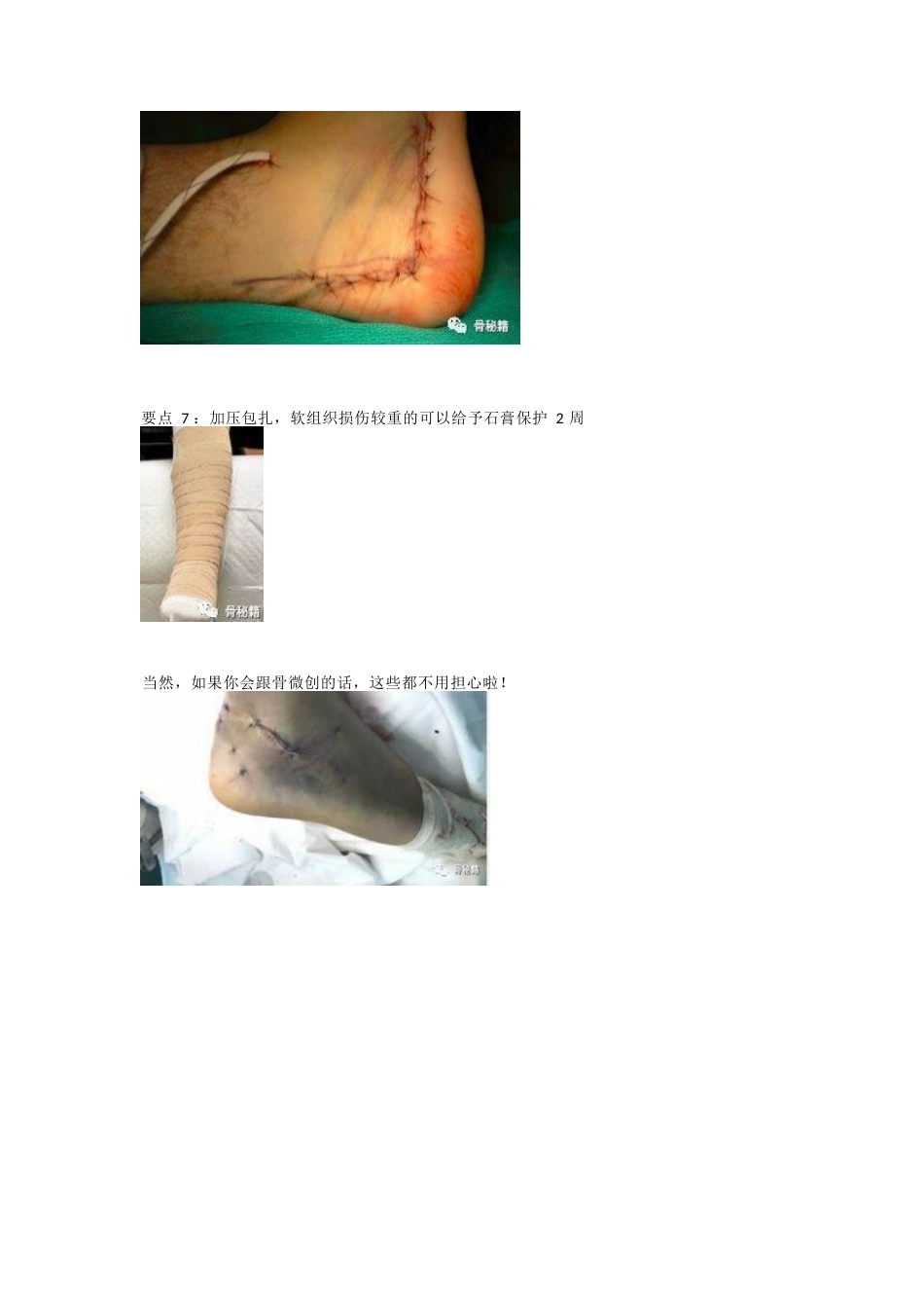 跟骨骨折的切口与 缝合技巧_第6页
