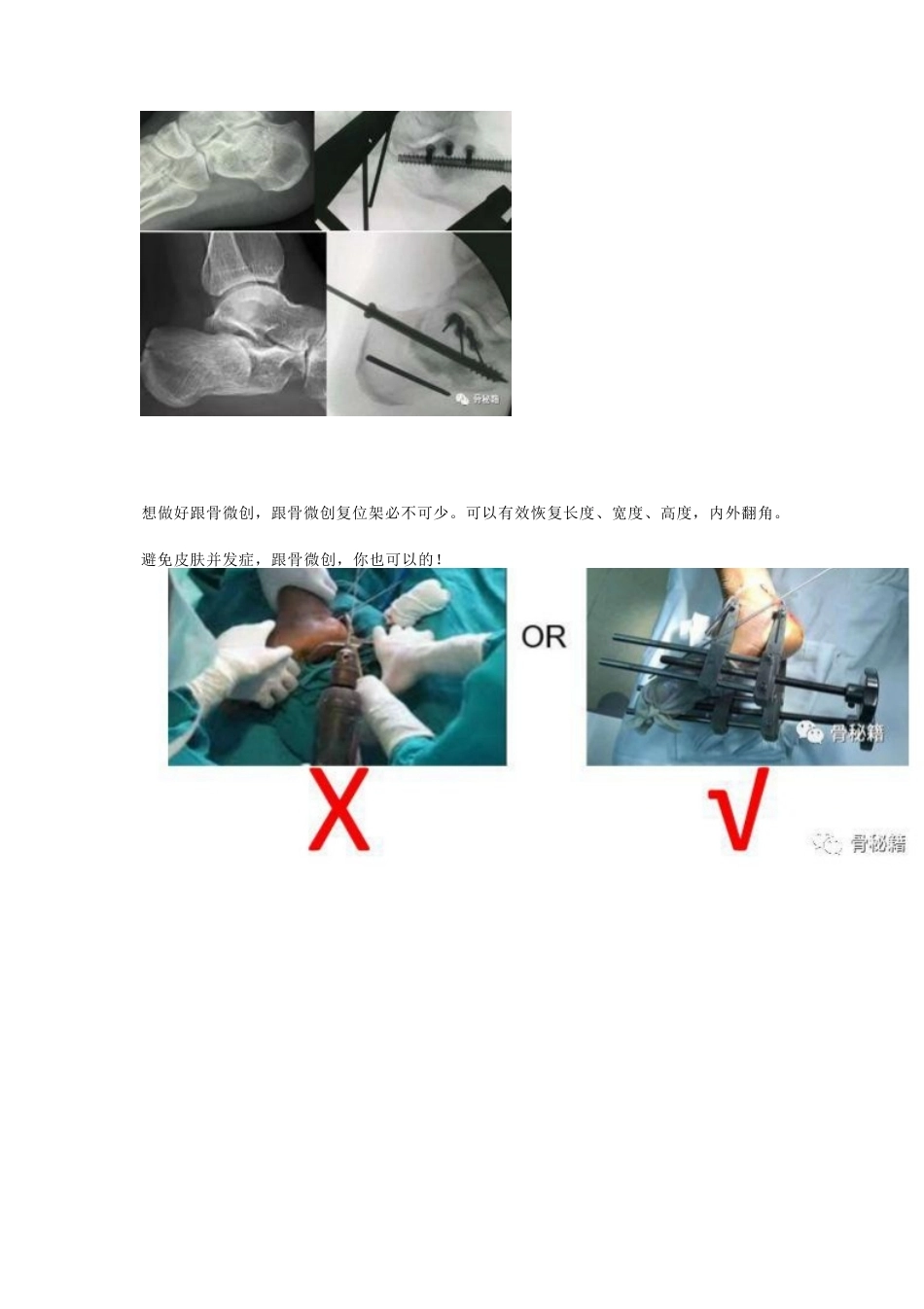 跟骨骨折的切口与 缝合技巧_第7页