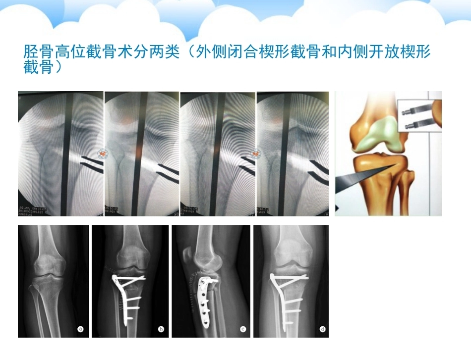 保膝治疗之一胫骨高位截骨术_第13页