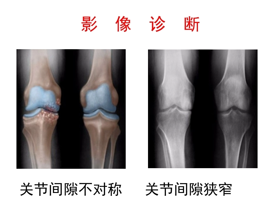 膝关节骨关 节炎_第15页