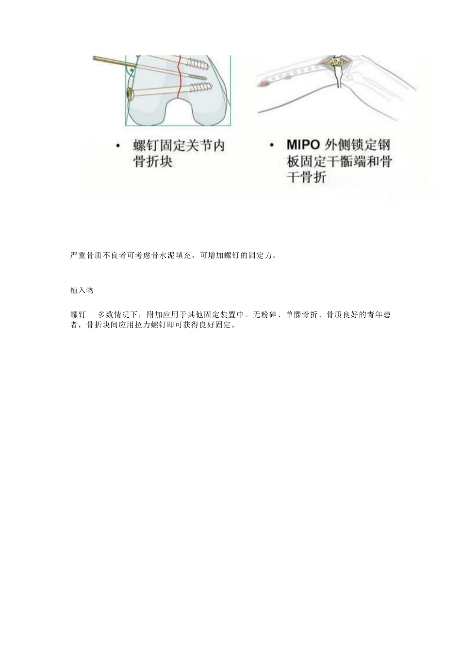 股骨远端骨折，固定方式决定手术成败_第10页