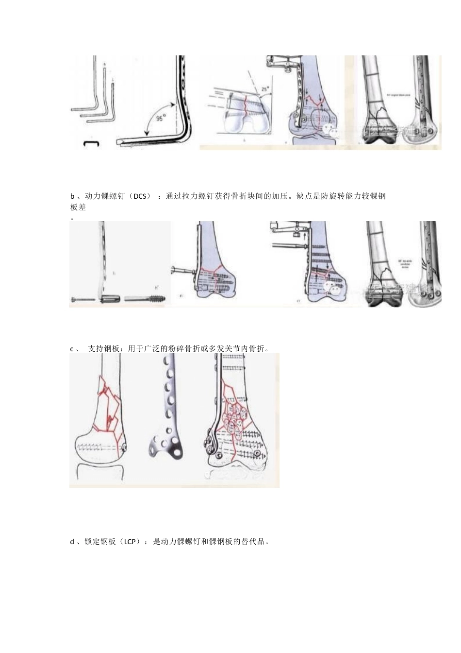 股骨远端骨折，固定方式决定手术成败_第12页