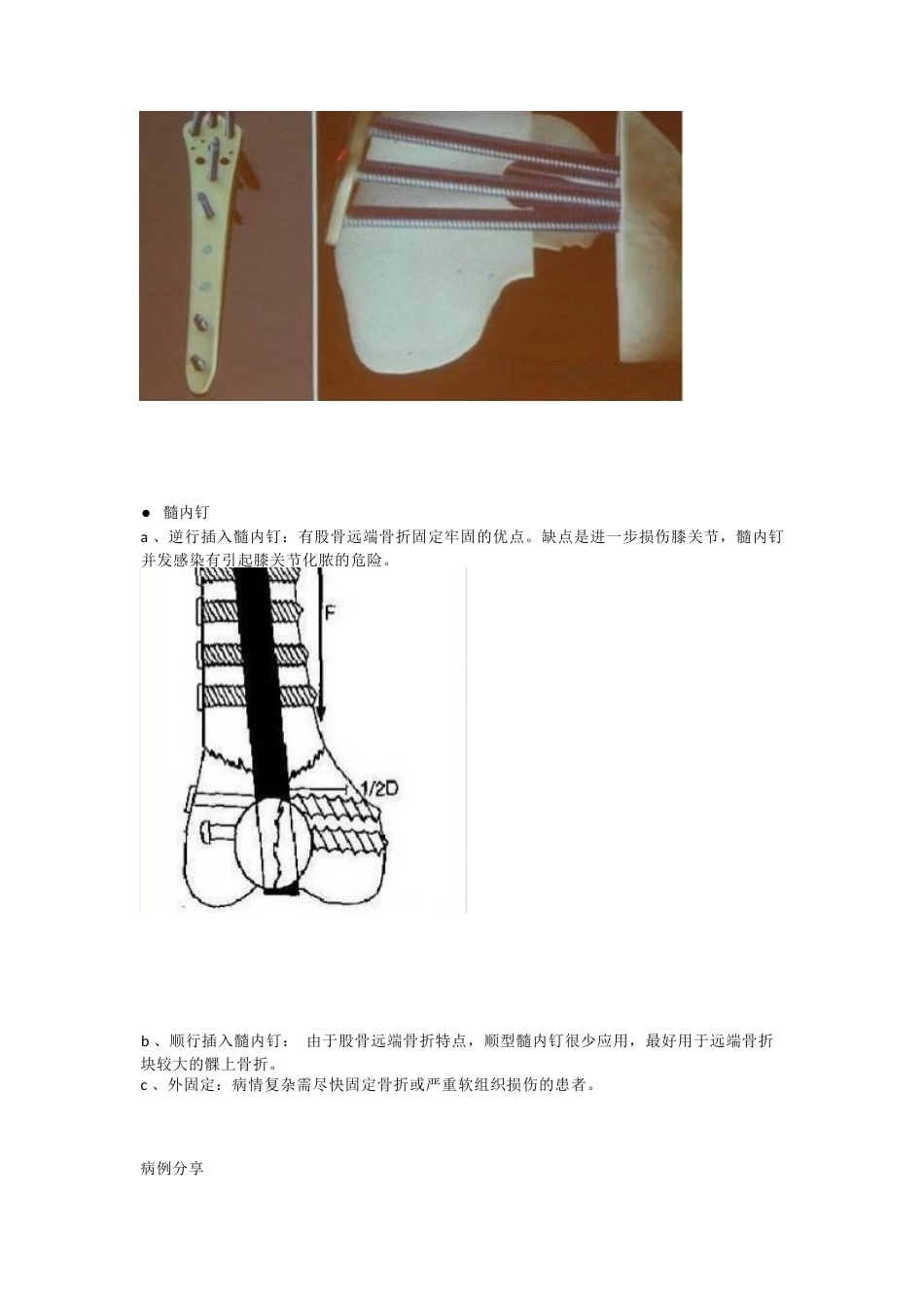 股骨远端骨折，固定方式决定手术成败_第13页