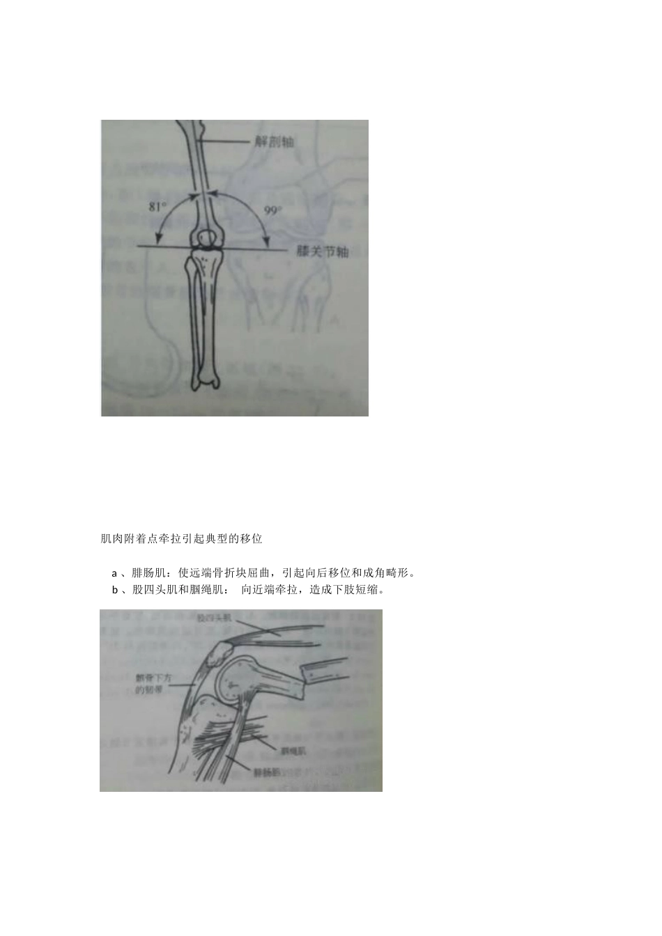 股骨远端骨折，固定方式决定手术成败_第4页