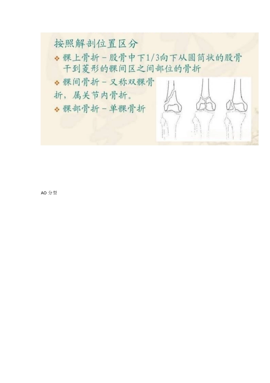 股骨远端骨折，固定方式决定手术成败_第7页