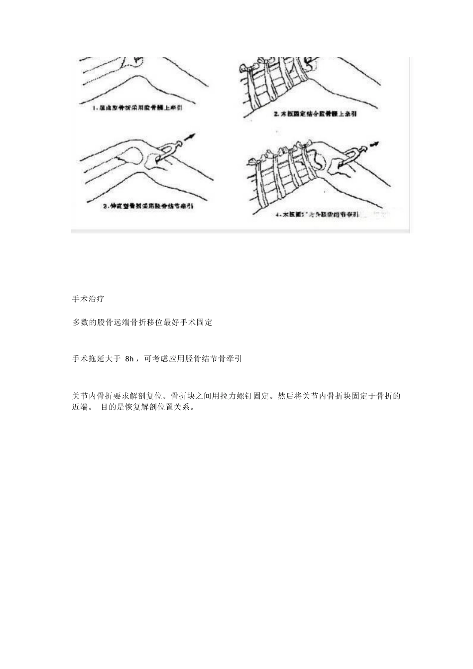 股骨远端骨折，固定方式决定手术成败_第9页