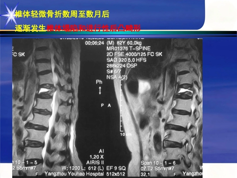 胸腰椎骨 折_第15页